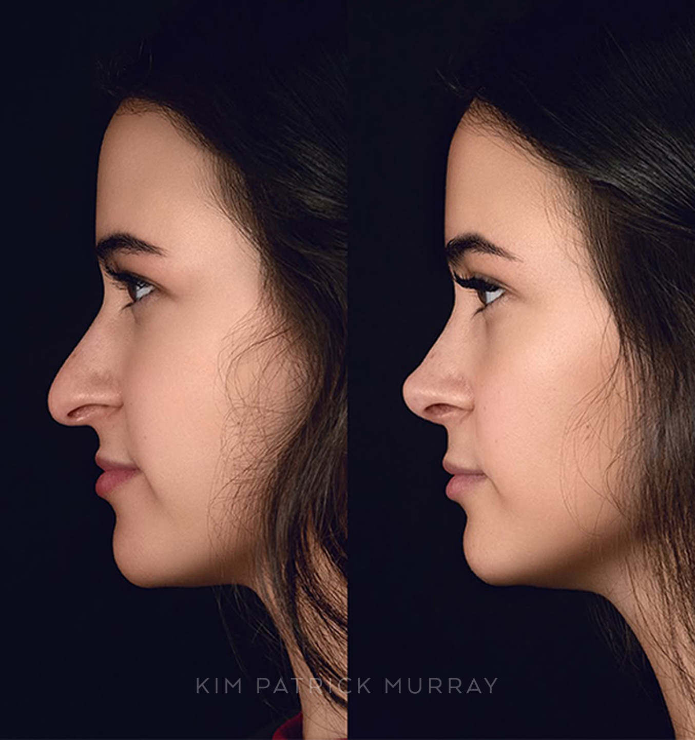featured-rhinoplasty-1