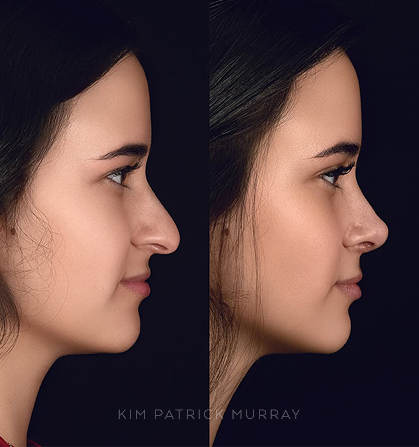 featured-rhinoplasty-2