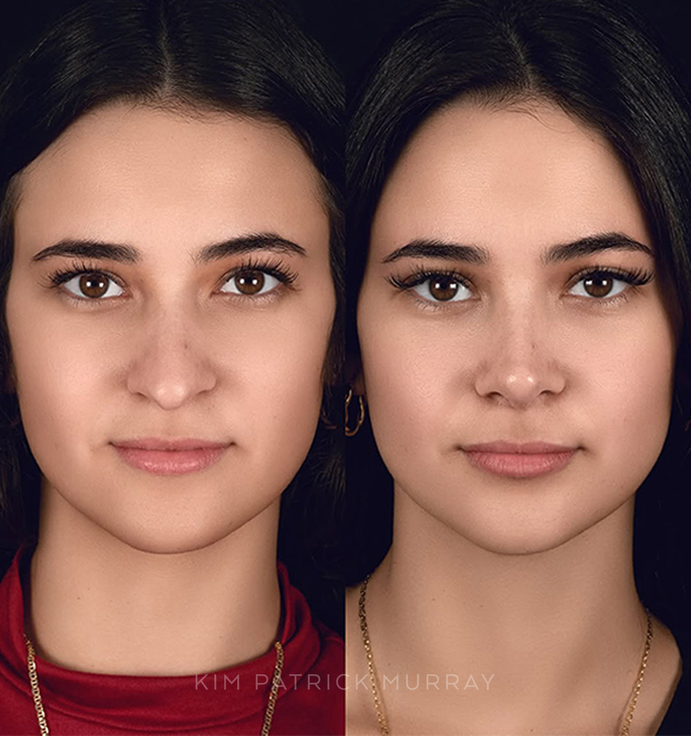 featured-rhinoplasty-3