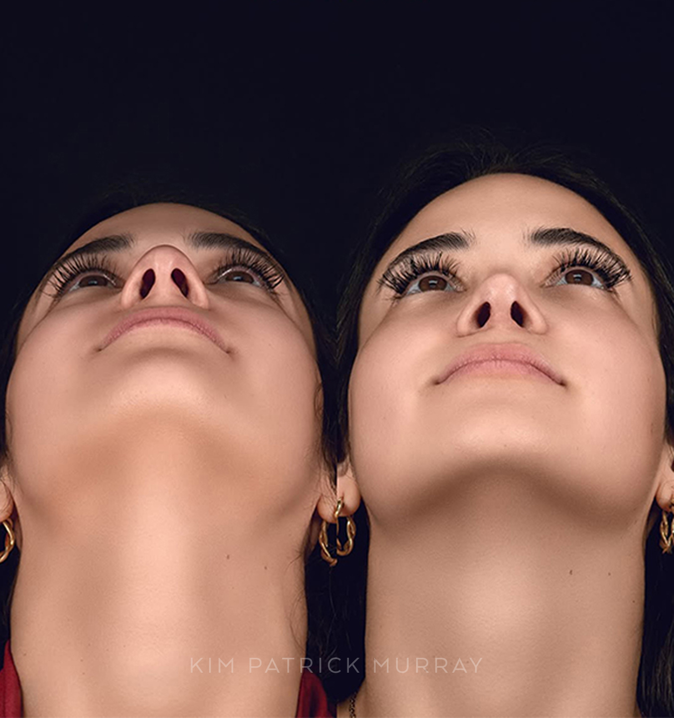featured-rhinoplasty-4