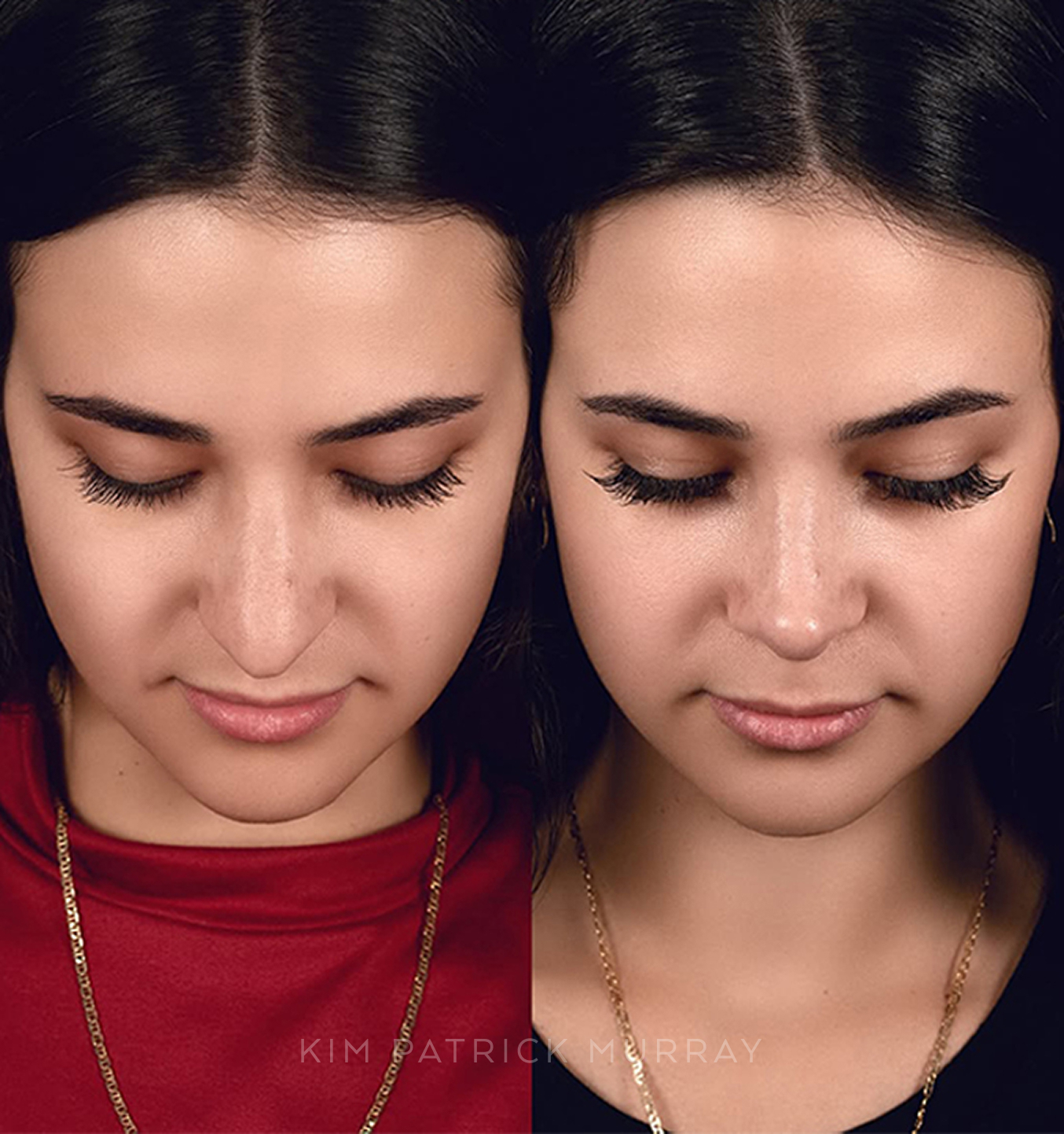 featured-rhinoplasty-5
