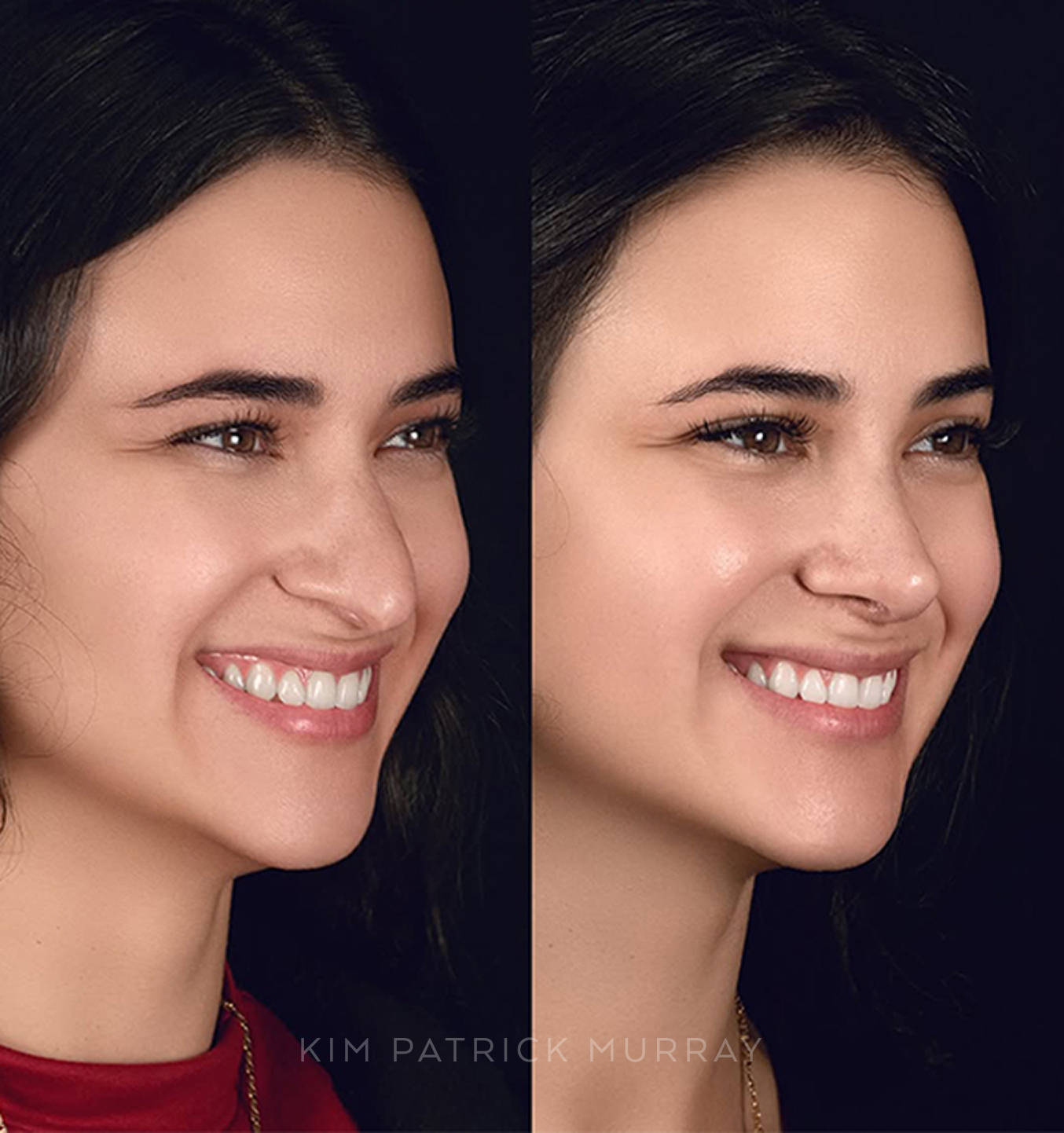 featured-rhinoplasty-6