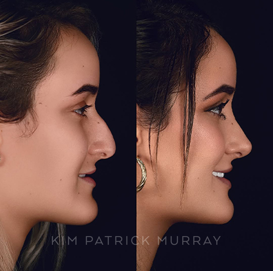 primary-rhinoplasty-before-after-1