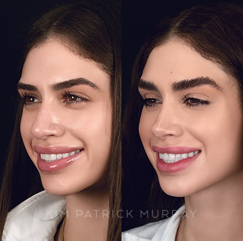 primary-rhinoplasty-before-after-10