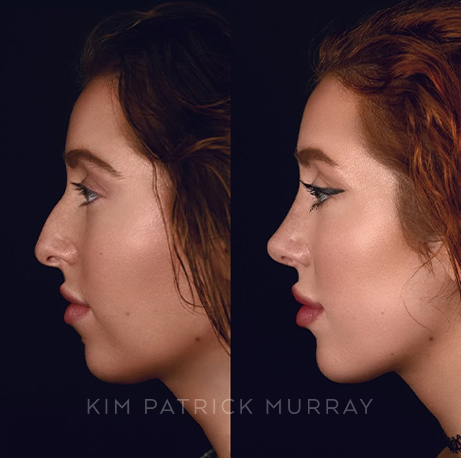 primary-rhinoplasty-before-after-2