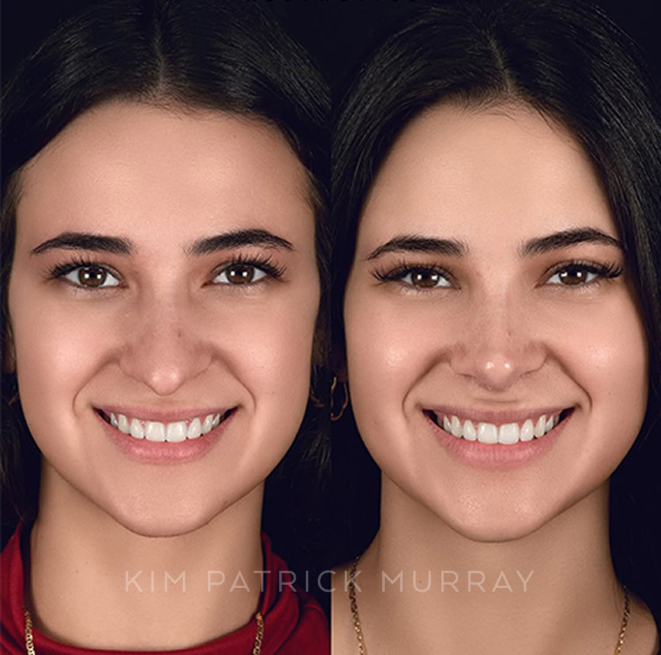primary-rhinoplasty-before-after-3