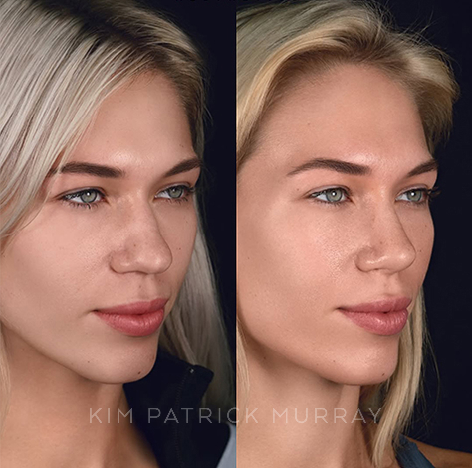 primary-rhinoplasty-before-after-4