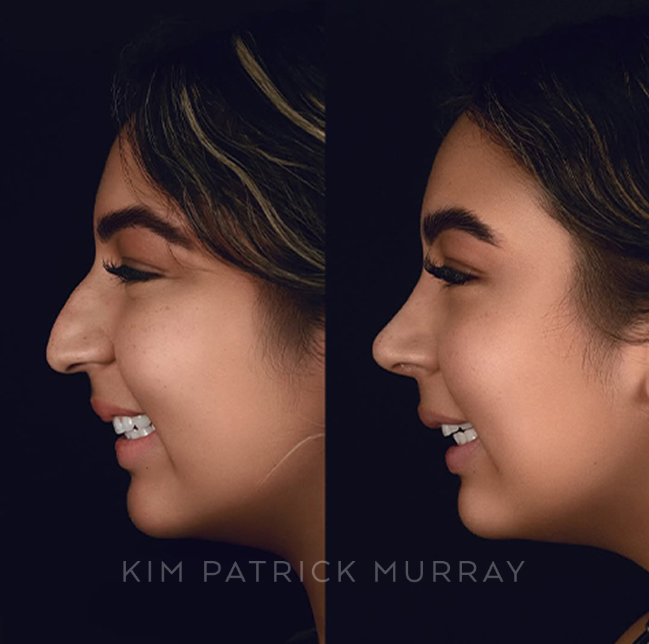primary-rhinoplasty-before-after-5