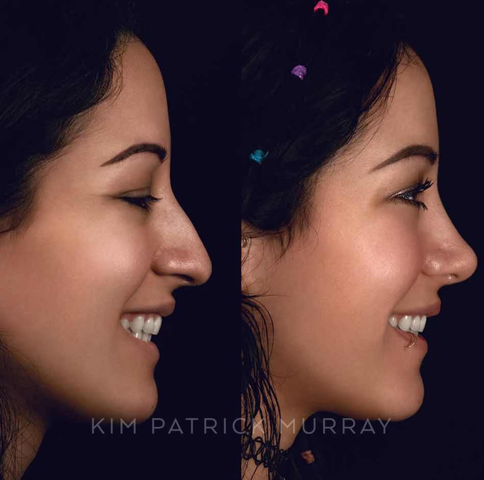 primary-rhinoplasty-before-after-6