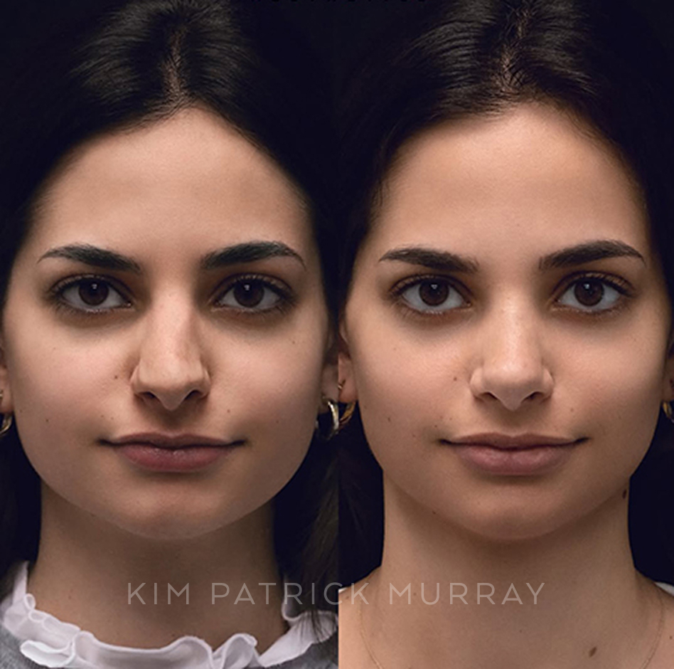 primary-rhinoplasty-before-after-7