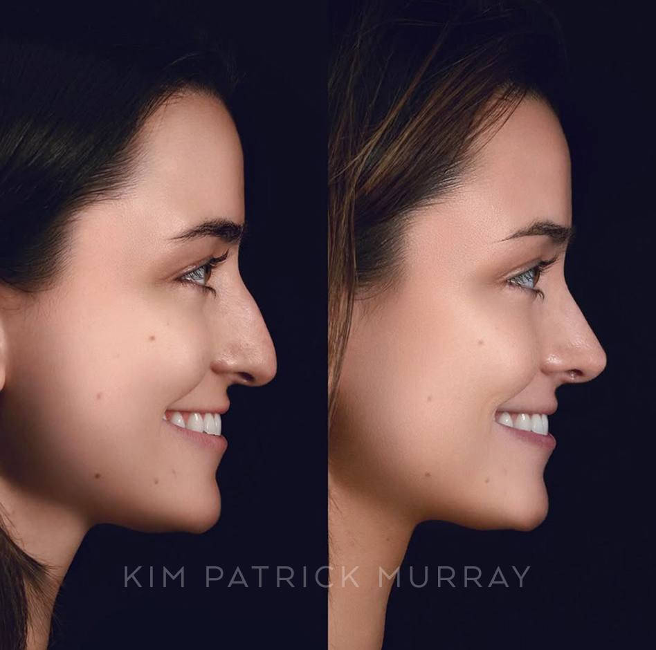 primary-rhinoplasty-before-after-8