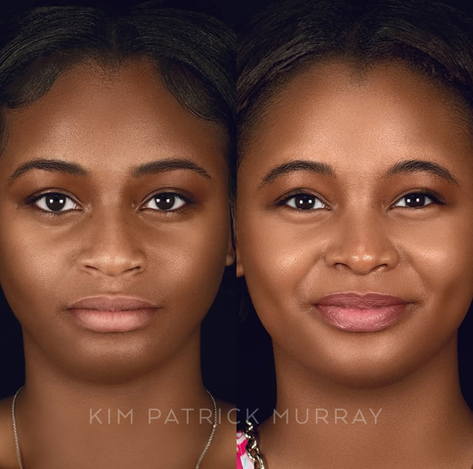 primary-rhinoplasty-before-after-9